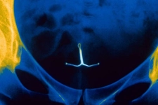 Spiral Karın Ağrısı Yapar mı?