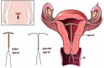 Gebelikten Korunma Spiral Kullanımı ve Faydaları Nelerdir?
