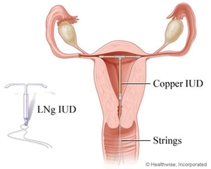Spiral Doğum Kontrol Kullanımı ve Faydaları Nelerdir?